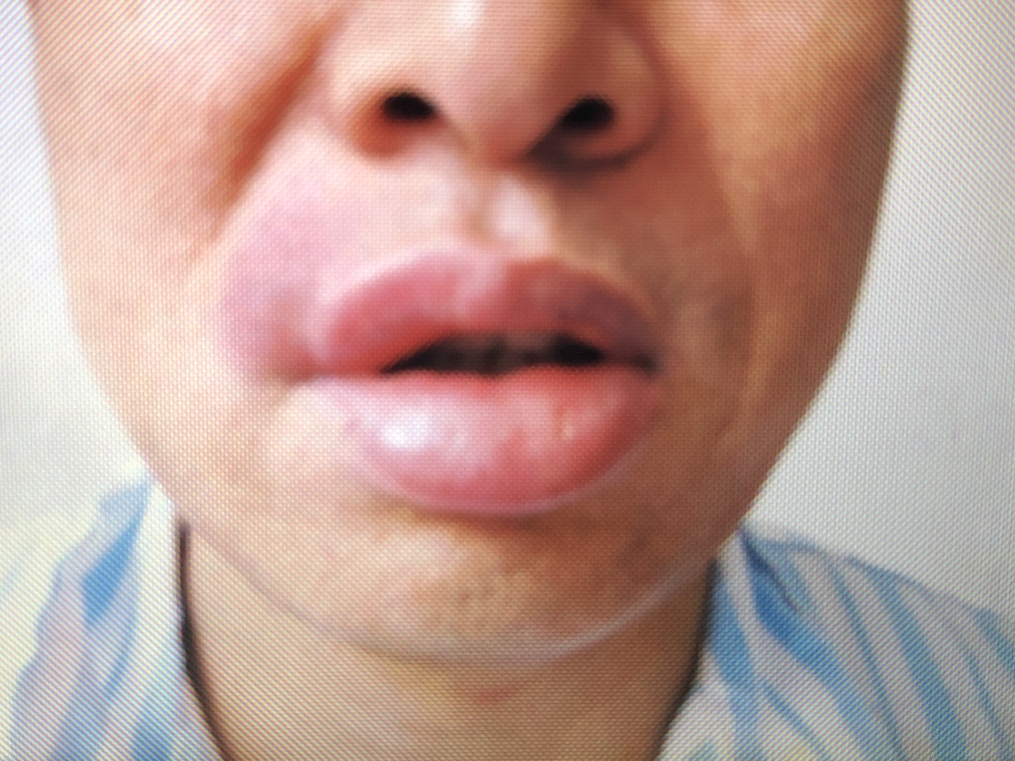 唇炎怎么治疗最有效图片