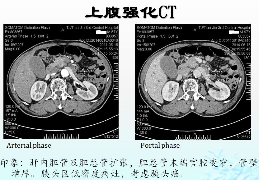 在線 白彧 認識加速康復外科 eras在胰十二指腸切除術(whipple'