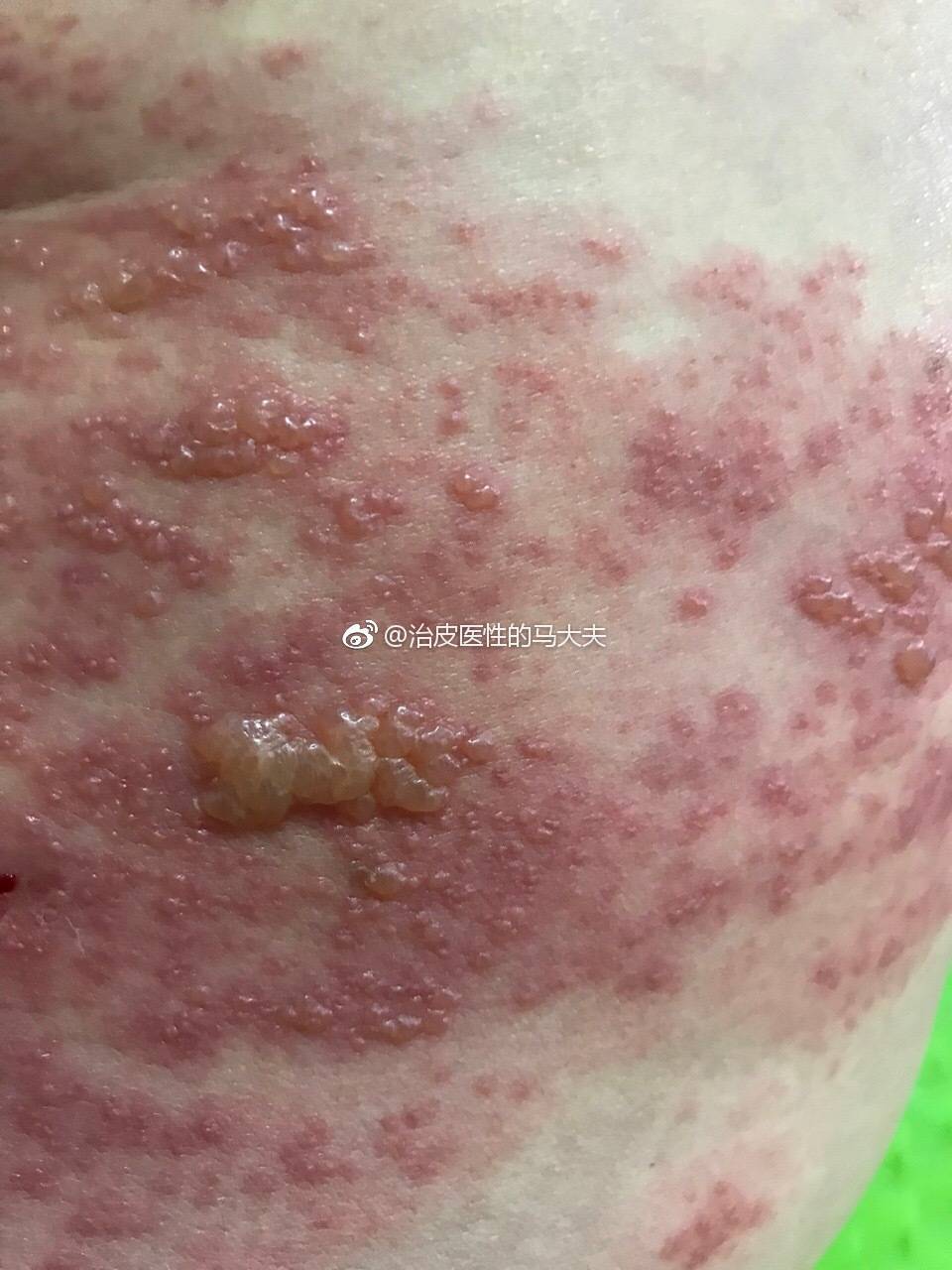 得了疱疹不用怕一辈子就一次