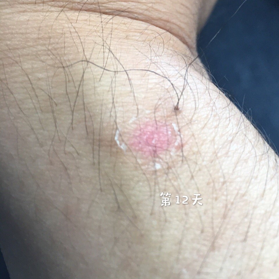 手部浅度烫伤的皮肤1个月变化过程 手部浅度烫伤的皮肤1个月变化过程