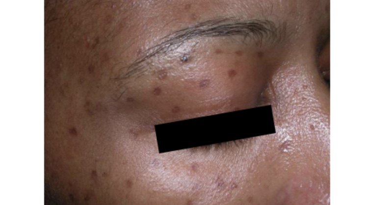 炎症后色素沉着,治疗手段都在这了 - 好大夫在线