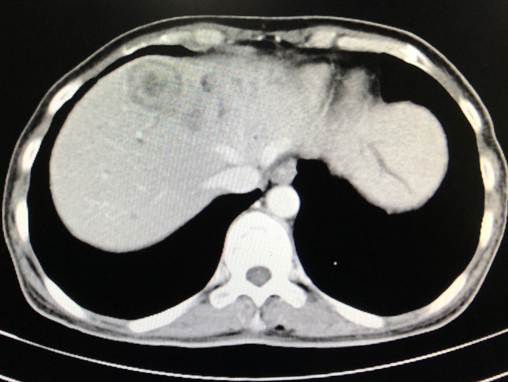 载药微球栓塞联合氩氦刀冷冻消融治疗肝转移瘤 - 好大夫在线