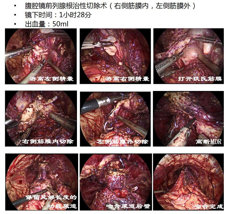 腹腔镜前列腺癌根治术几点小体会 - 好大夫在线