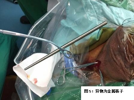 近日我院泌尿外科急诊收治一例尿道异物的患者,我科崔林教授团队精心