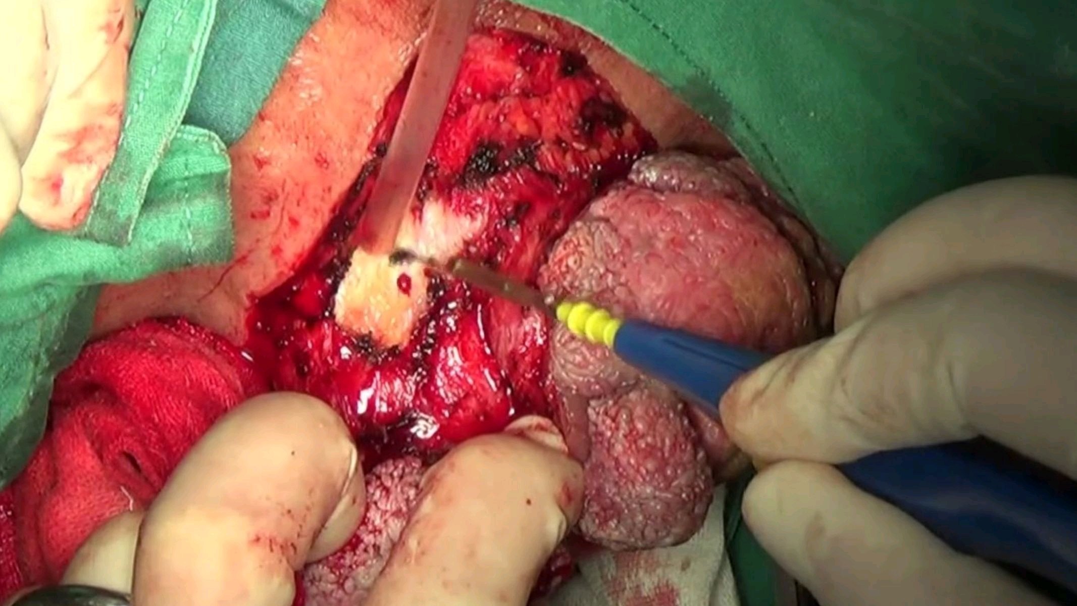 肛周长出巨大"菜花"?普外专家妙手"摘花"——市中心医院 - 好大夫在线