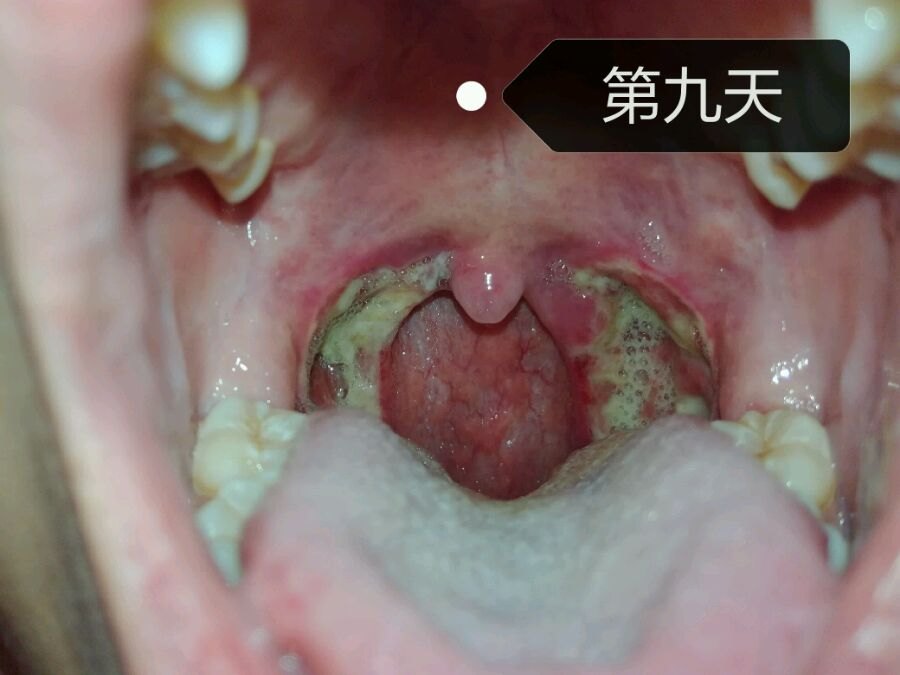 腺样体扁桃体切除术后注意事项 小儿腺样体肥大 日常护理 饮食运动 好大夫在线 腺样体扁桃体切除术后注意事项 小儿腺样体肥大 日常护理 饮食运动 好大夫在线