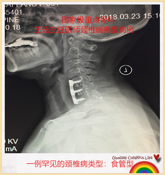 病例70:一例罕见的颈椎病类型:食管型 