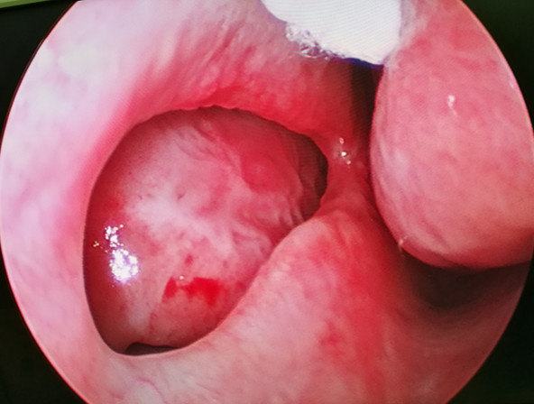 鼻中隔鼻中隔前部穿孔巨大,前后径达到2.5cm(见图1),且伴有鼻窦炎.