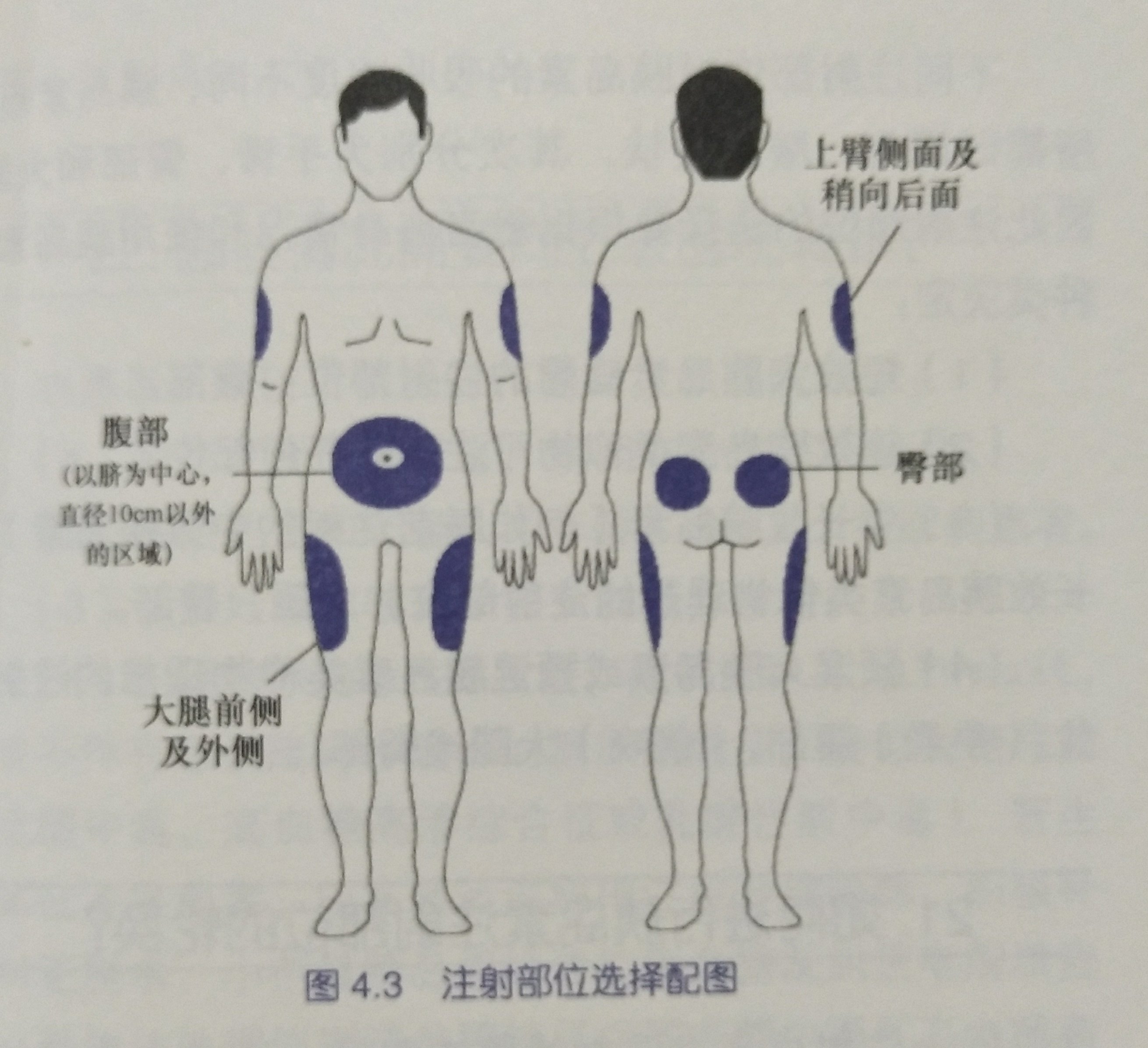 胰岛素注射部位选择