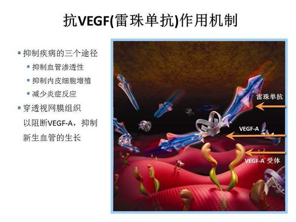 黄斑水肿了,抗vegf治疗,我该选国产还是进口呢? - 好大夫在线