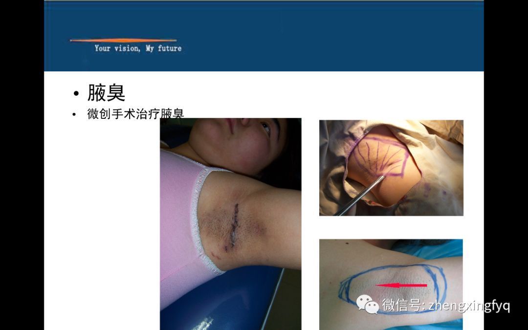 腋臭治疗方法