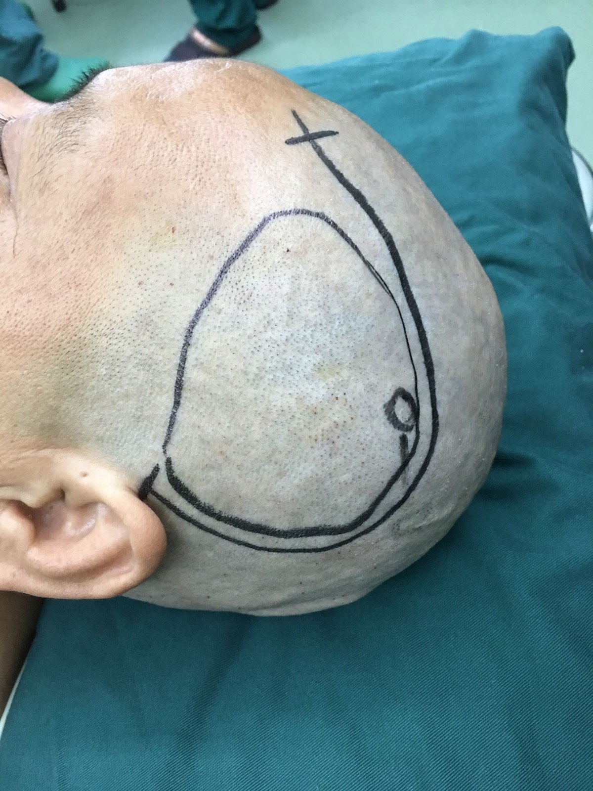 烟雾病搭桥手术(动脉搭桥 颞肌贴敷 硬脑膜翻转手术) - 好大夫在线