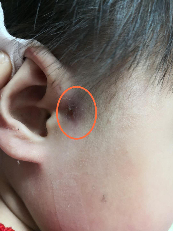 耳前瘘管反复感染怎么办?