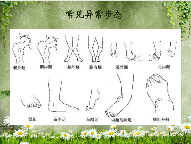 异常步态 - 好大夫在线