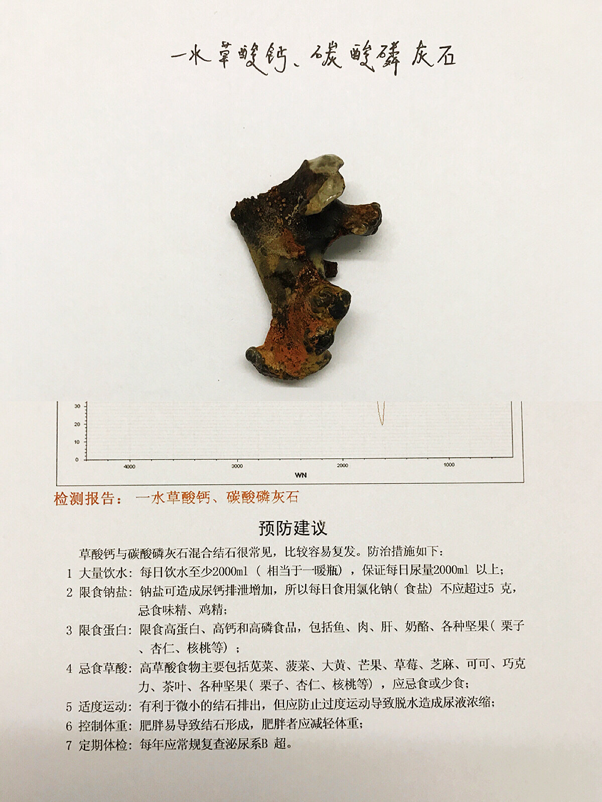 泌尿系结石是可以这样预防的 - 好大夫在线