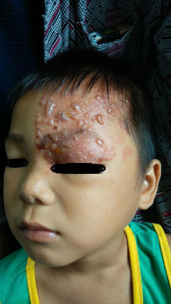 这是个典型的儿童头面部带状疱疹