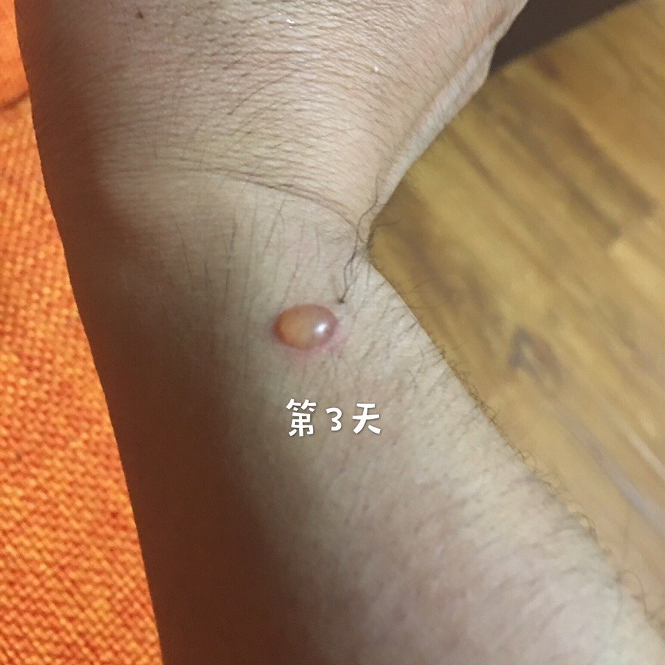 手部浅度烫伤的皮肤1个月变化过程