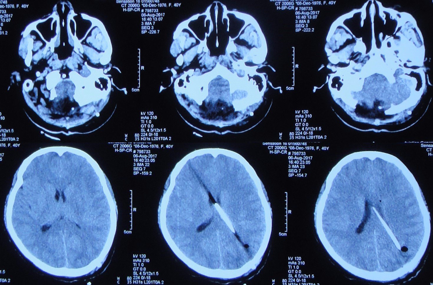 腦脊液科挽救小腦扁桃體下疝畸形減壓術後的早期腦幹周感染 - 好大夫