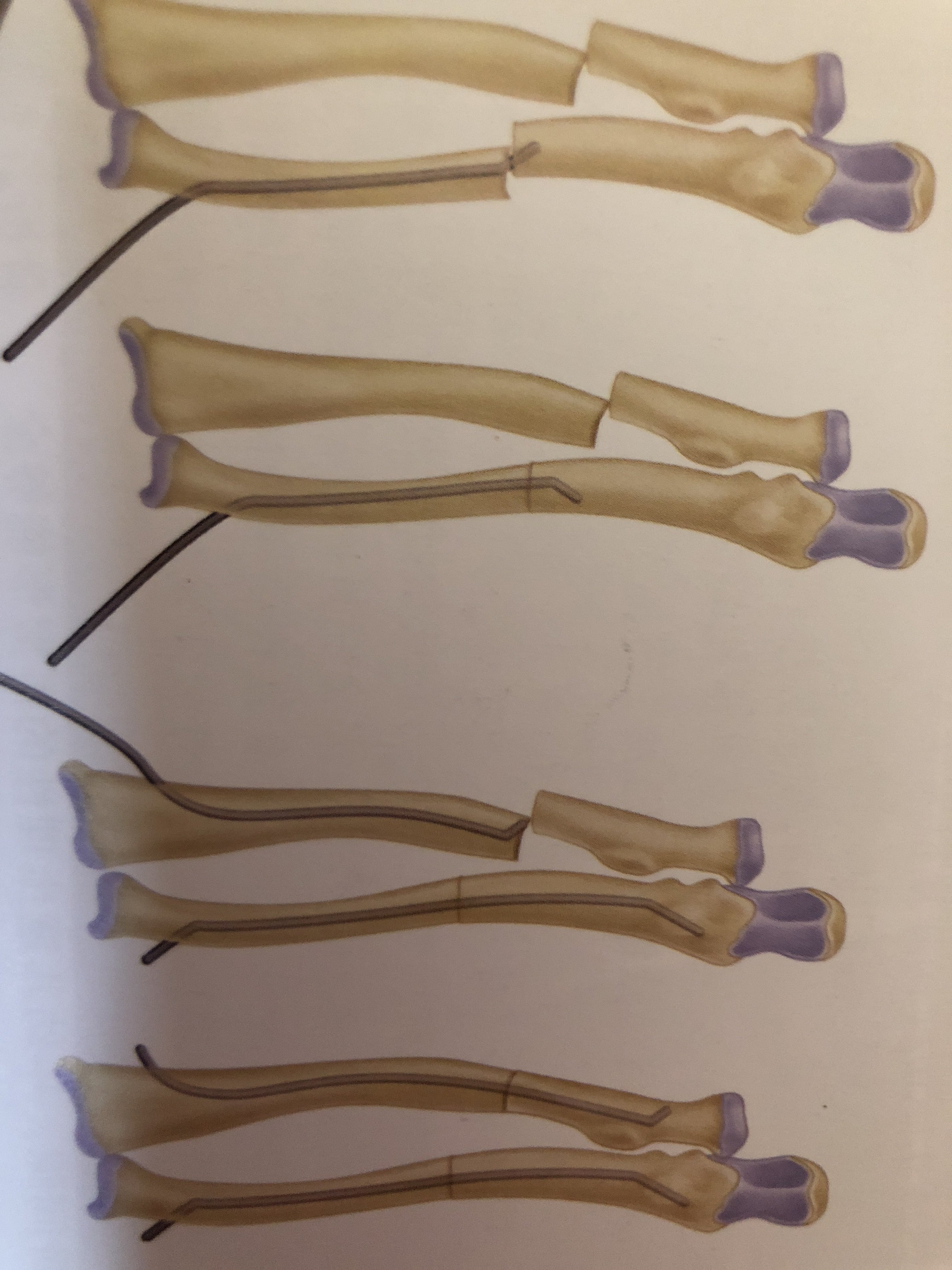  10岁儿童可采用弹性隧内针固定,通过桡骨远端干骺端及尺骨近端干骺端