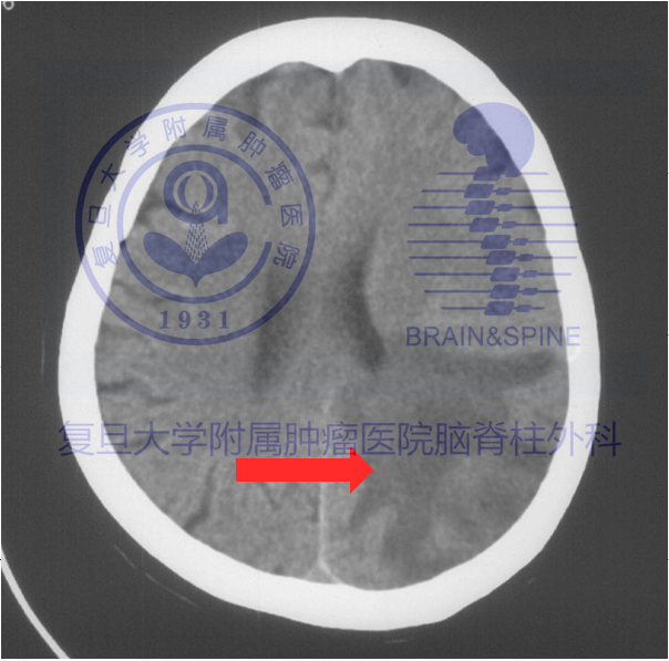 郝斌 > 膠質瘤腦膠質瘤的檢查手段主要有ct,mri核磁共振和腦電圖等