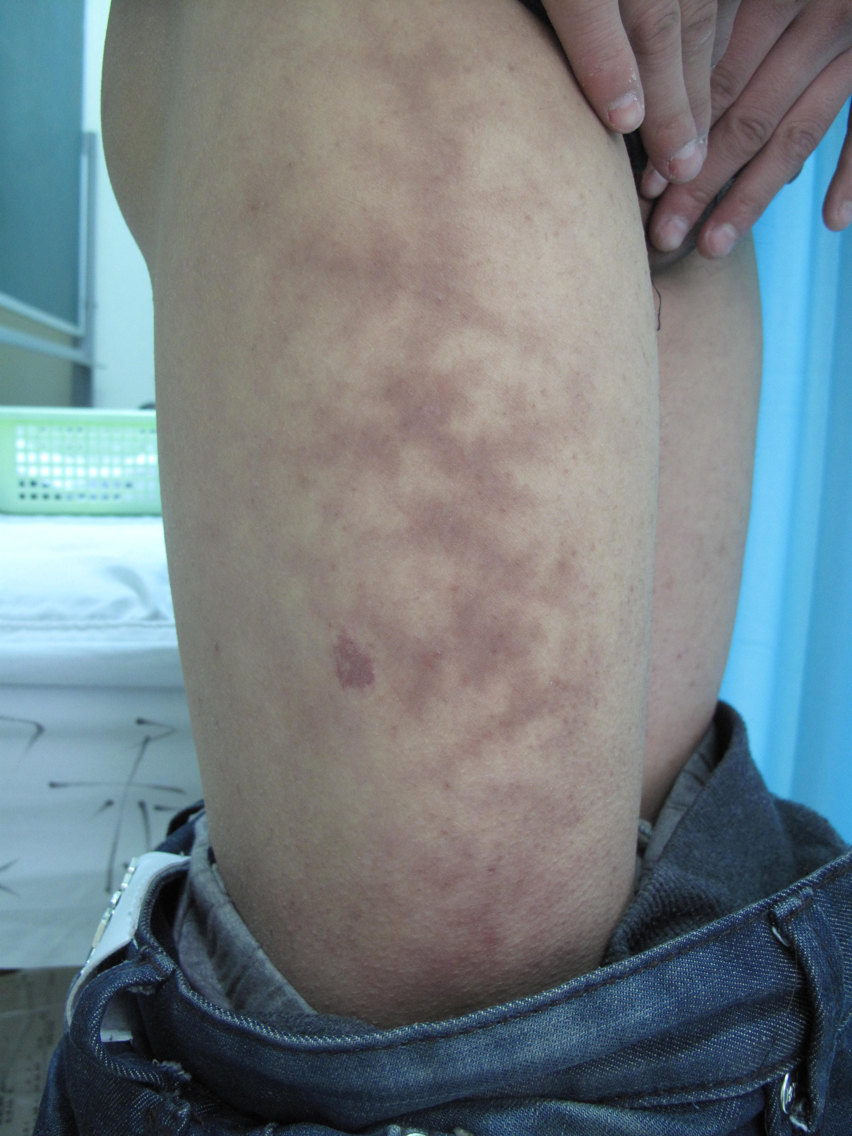 火激红斑 色素性紫癜 疾病介绍