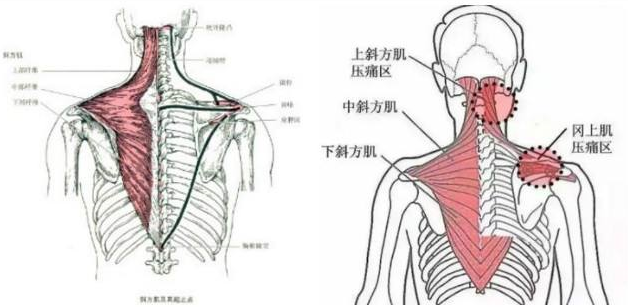 痛病悟源-背部肌筋膜炎