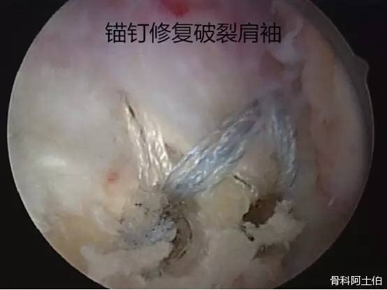 修復完成的肩袖(肩關節鏡下視野)肩關節鏡手術目前已較為成熟,與傳統