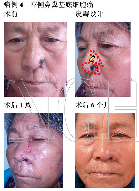 颜面部基底细胞癌的治疗—局部皮瓣的应用 - 好大夫在线