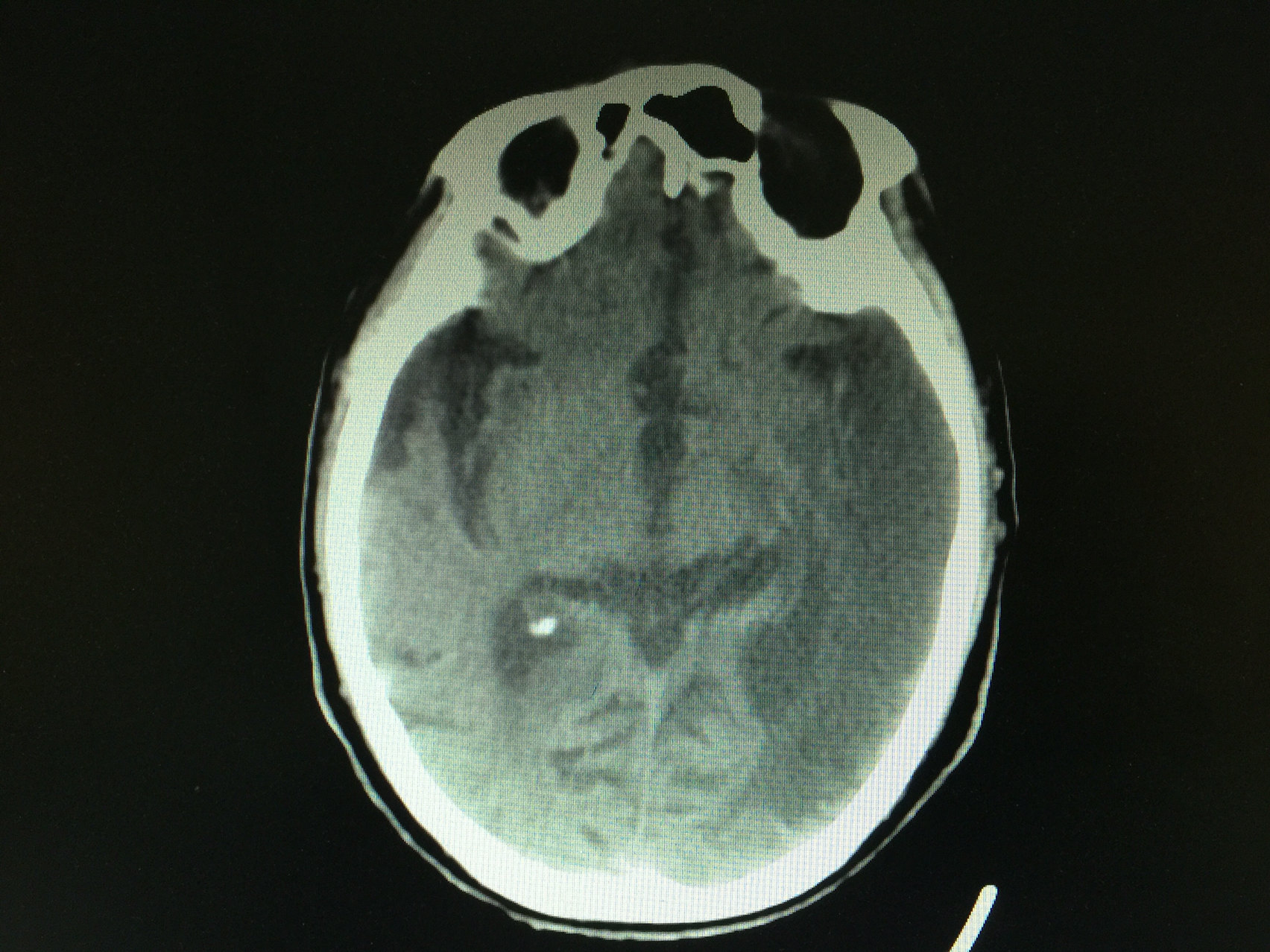 94岁老人大面积脑梗后血性胸腔积液没有手术