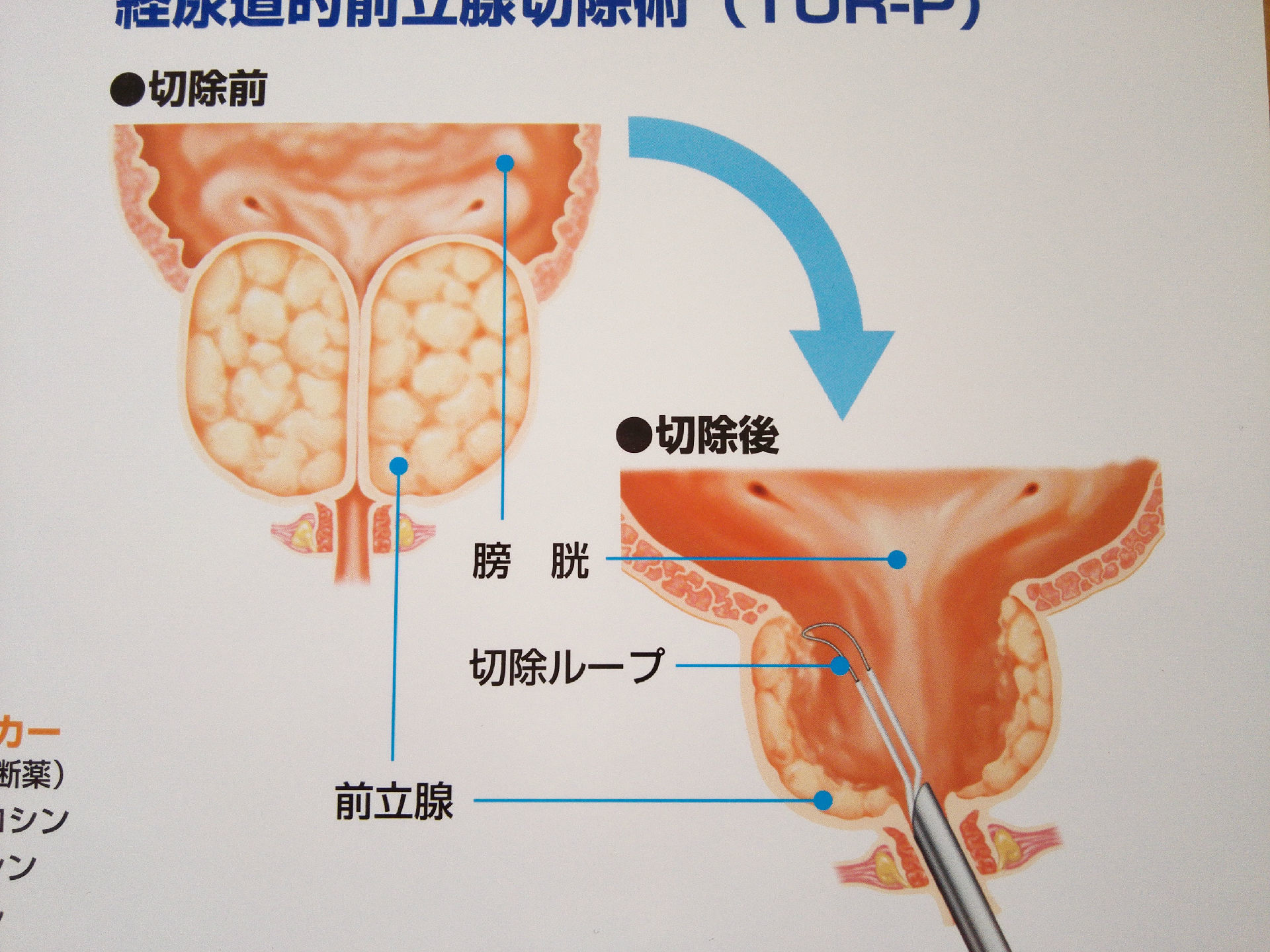 前列腺增生手术示意图图片