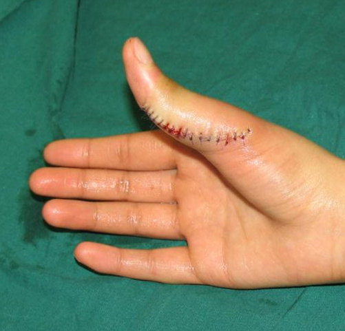 大人六个手指头可以切除,六指手术前后的图片,6个指头小孩 