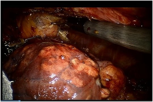 机器人手术切除巨大胸腺瘤一例 - 好大夫在线