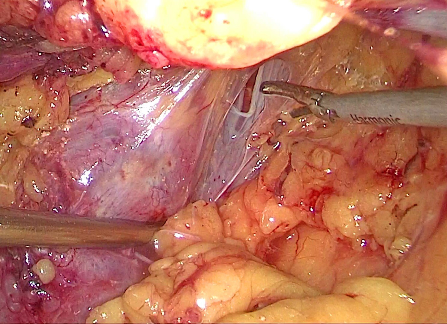 肾囊肿会复发和癌变吗_肾癌_预后_发病原因 - 好大夫在线