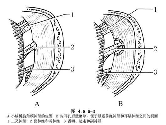 難治性眩暈(梅尼埃病)手術治療:耳後小切口前庭神經切斷術