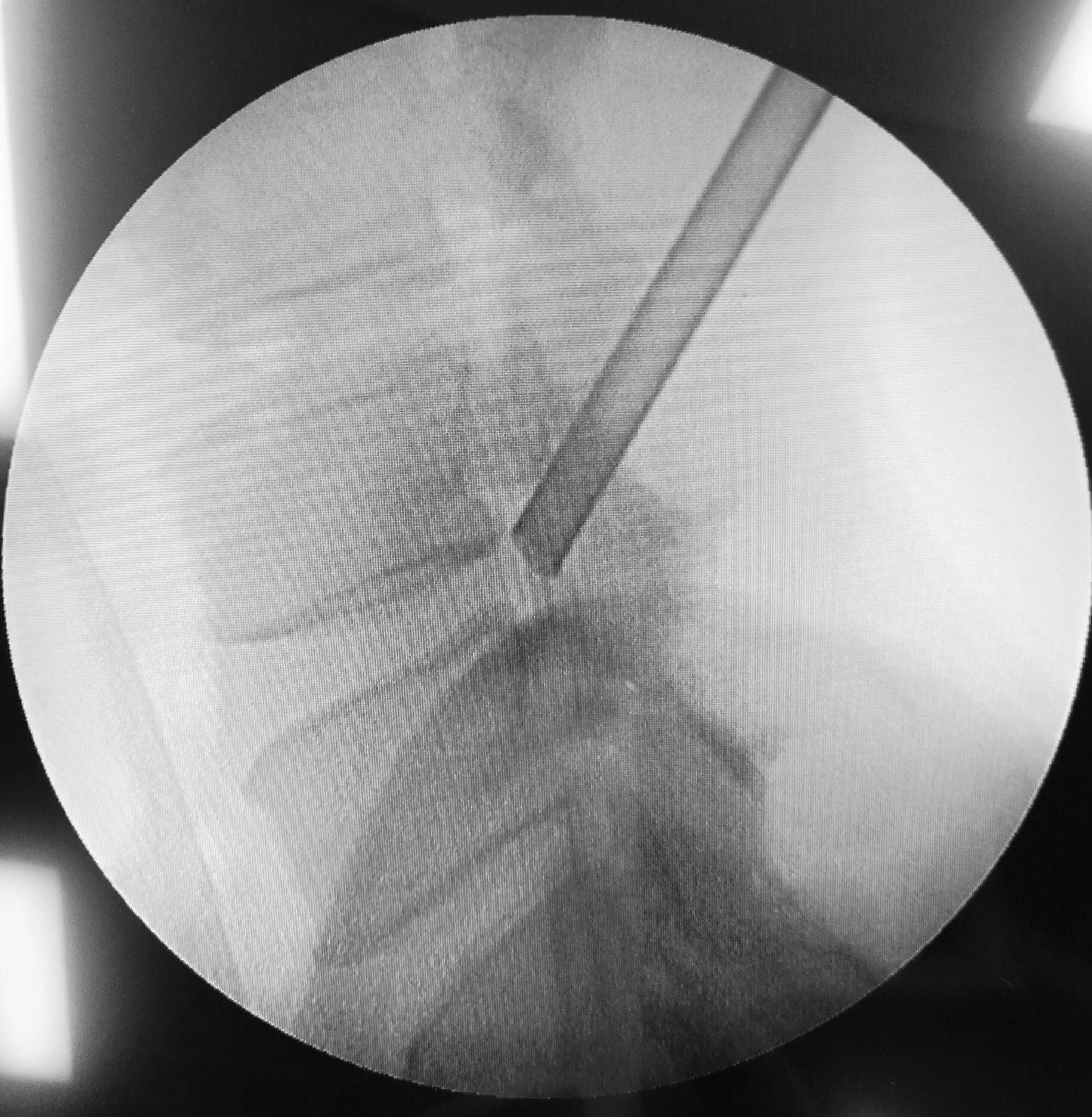 什么是椎间孔镜技术