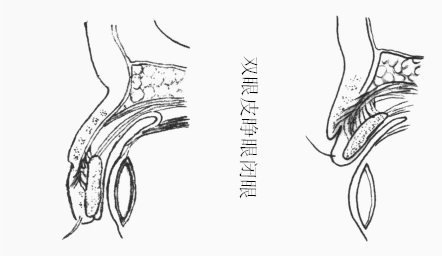 双眼皮原理_副本.png