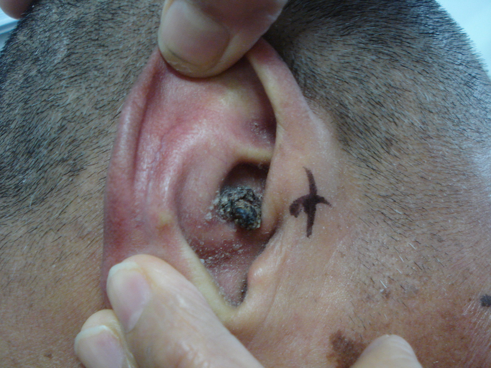 耳廓黑色素瘤早期图片图片