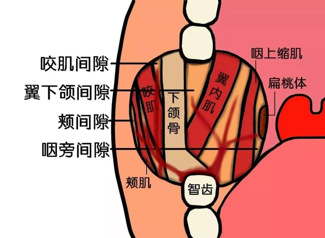 咬肌间隙感染化脓图片图片