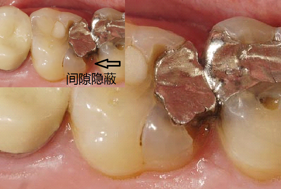 我是如何处理食物嵌塞 - 好大夫在线