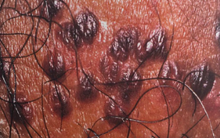 女性丘疹尖锐湿症状图片