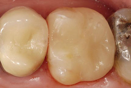 我是如何处理食物嵌塞