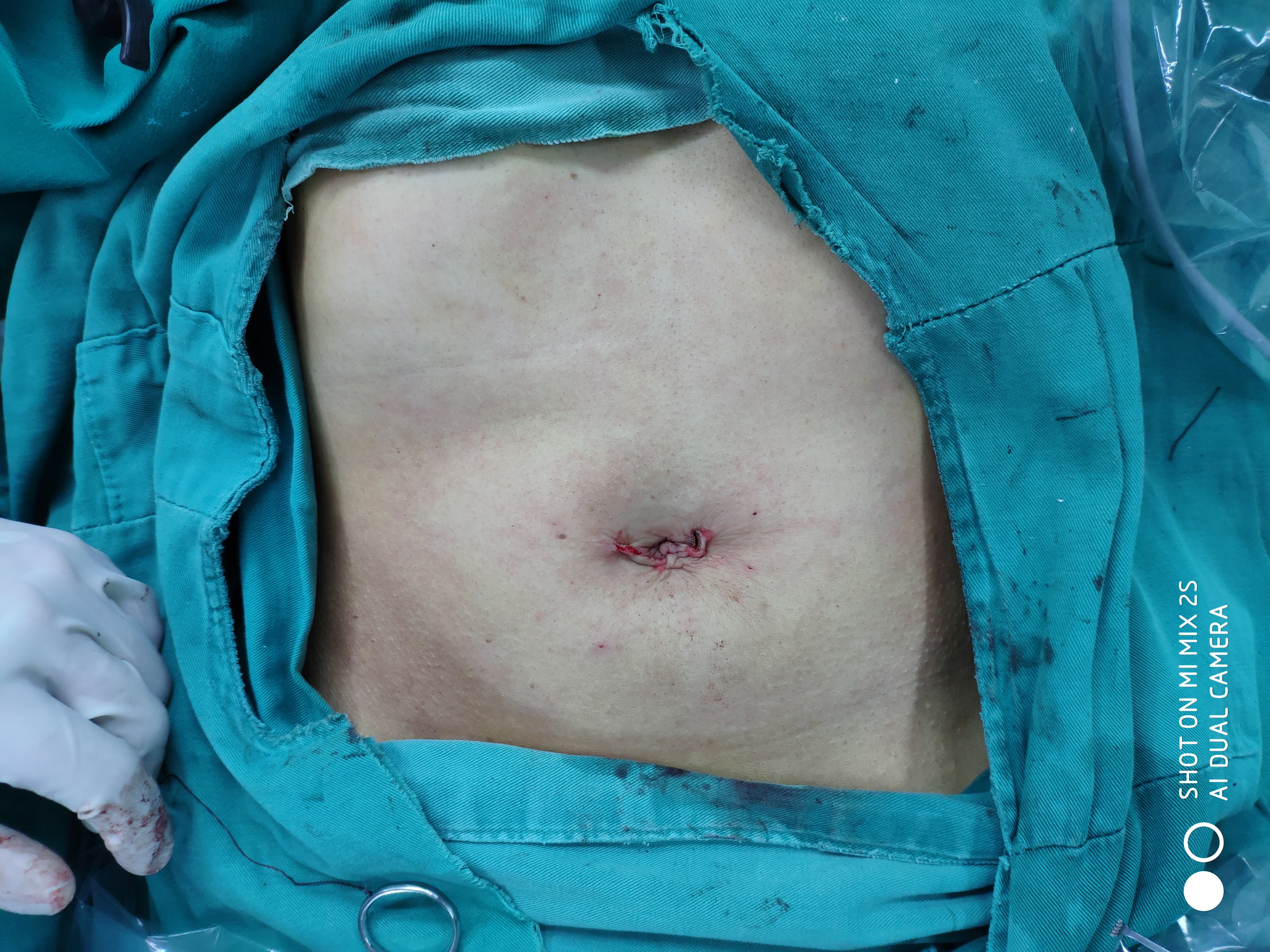 单孔腹腔镜手术伤口图图片
