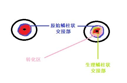 生理鱗柱狀交接部:受陰道酸性環境和致病微生物影響,紅色的柱狀上皮被