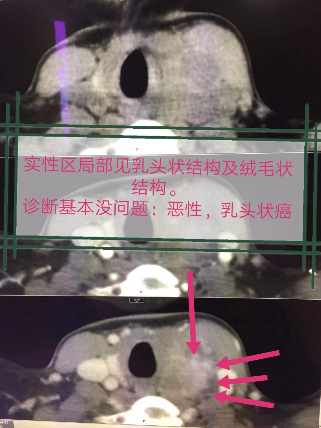 甲状腺乳头状癌经典ct