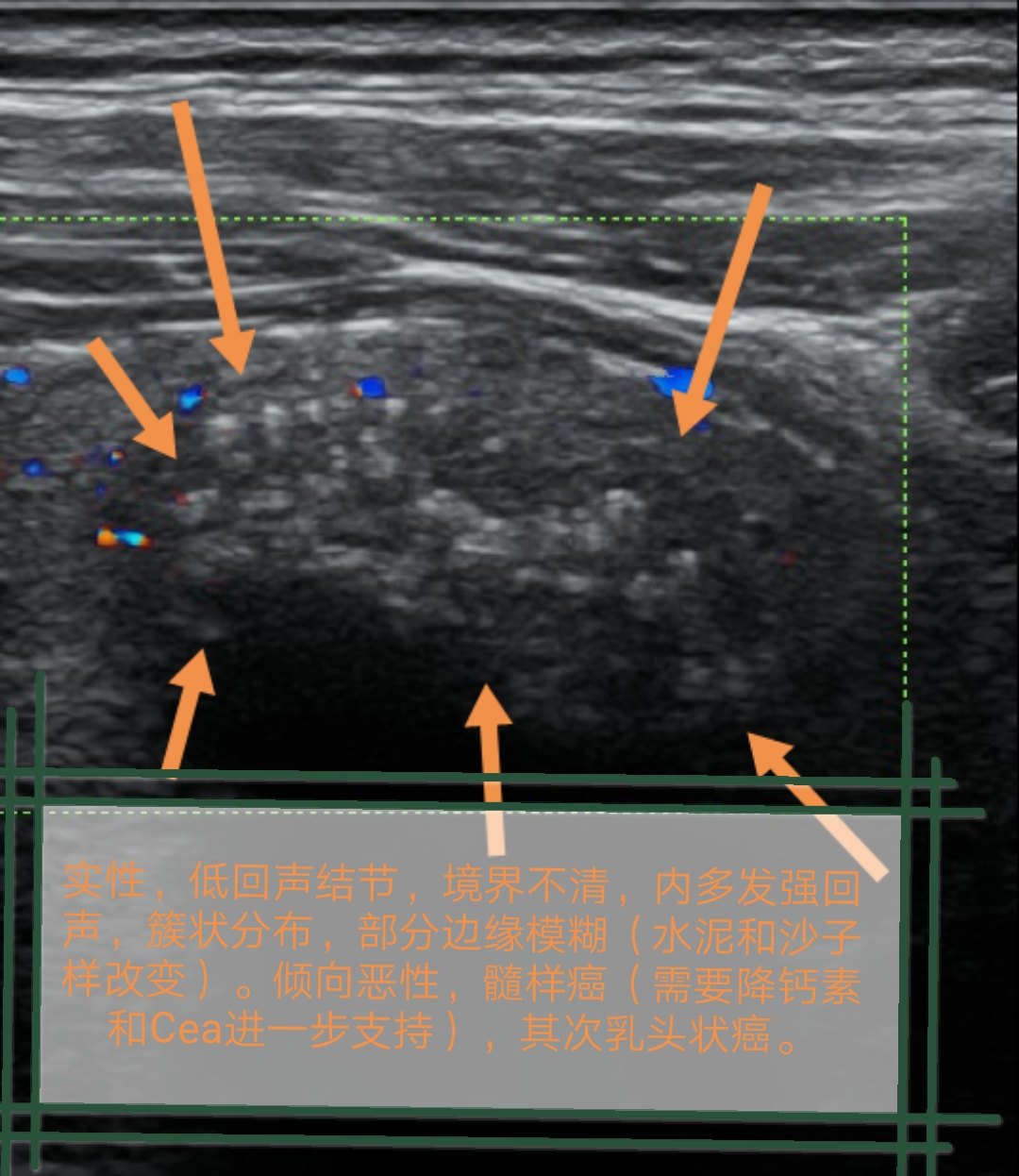 超声诊断甲状腺髓样癌1例 - 好大夫在线