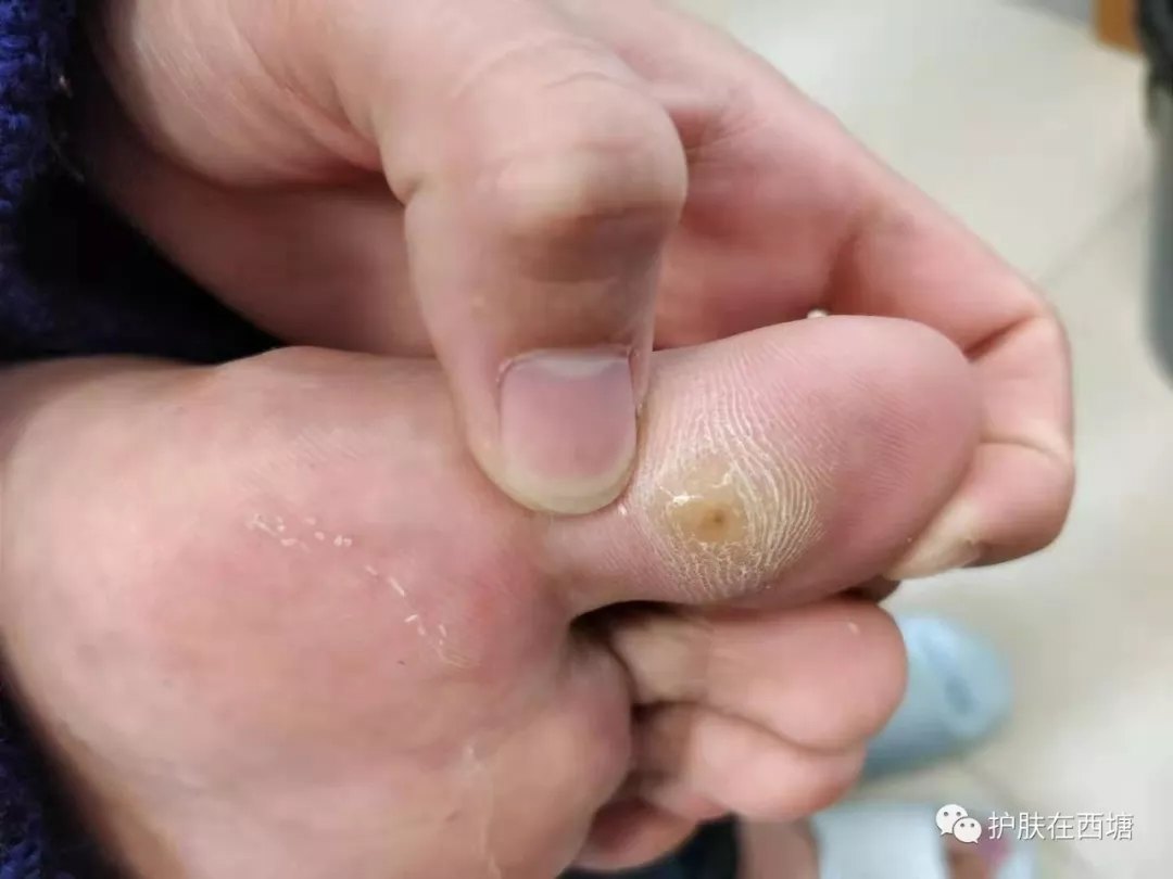 令人寸步难行的鸡眼 - 好大夫在线