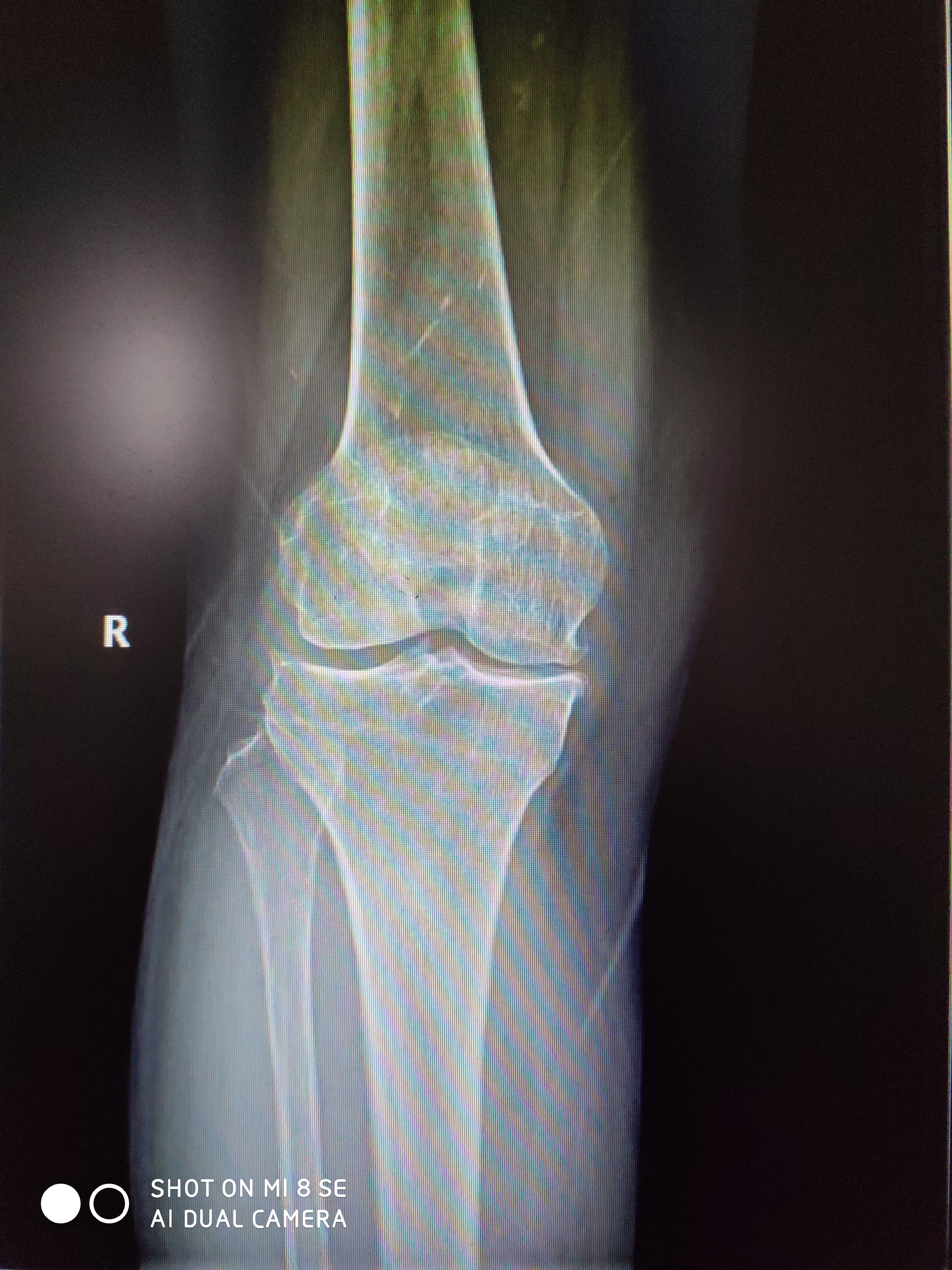正常膝关节x线平片图片