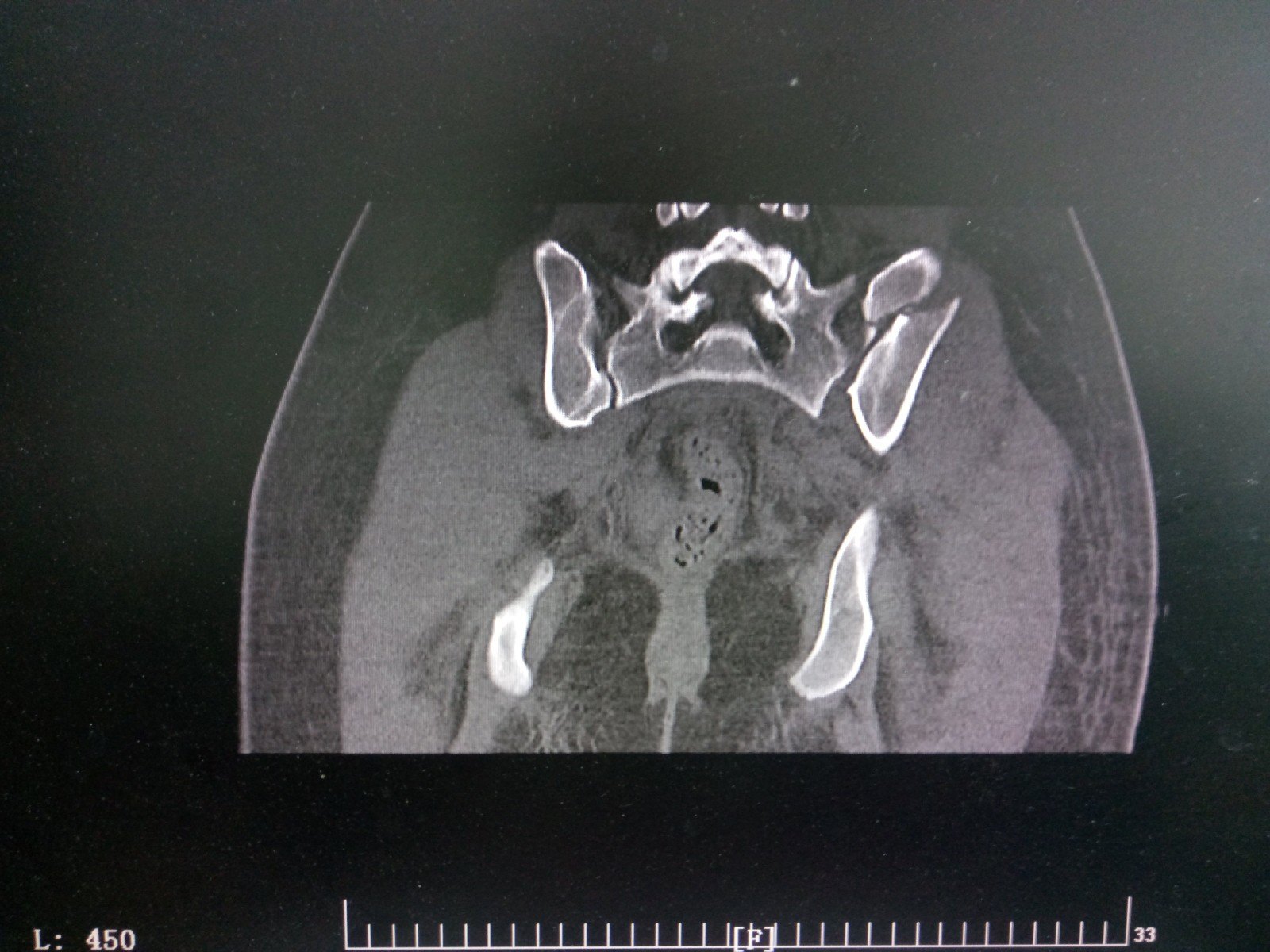 好大夫在线 朱泽兴 > 骨盆骨折的微创治疗(典型病例