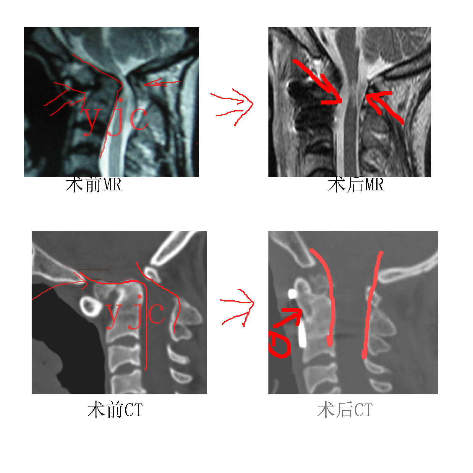 陳舊性齒突骨折寰樞椎脫位經口手術理想復位並解除神經壓迫