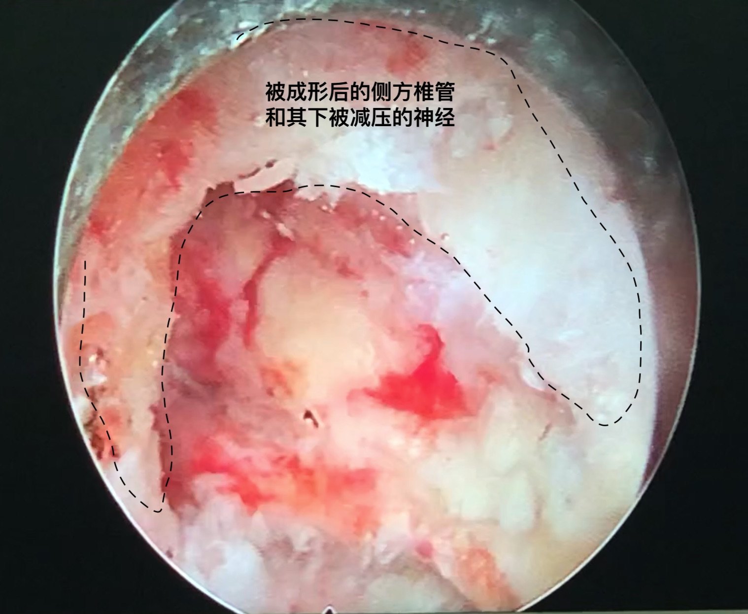 微创内镜行腰椎侧隐窝狭窄